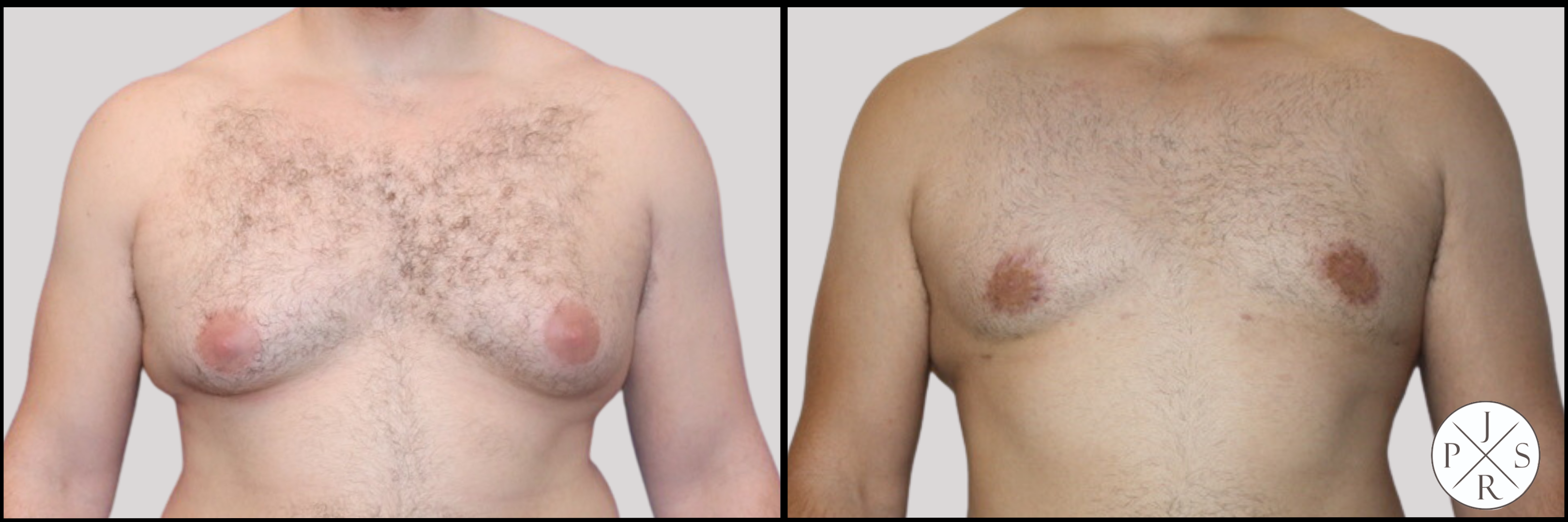 Gynaecomastia Before & After Image